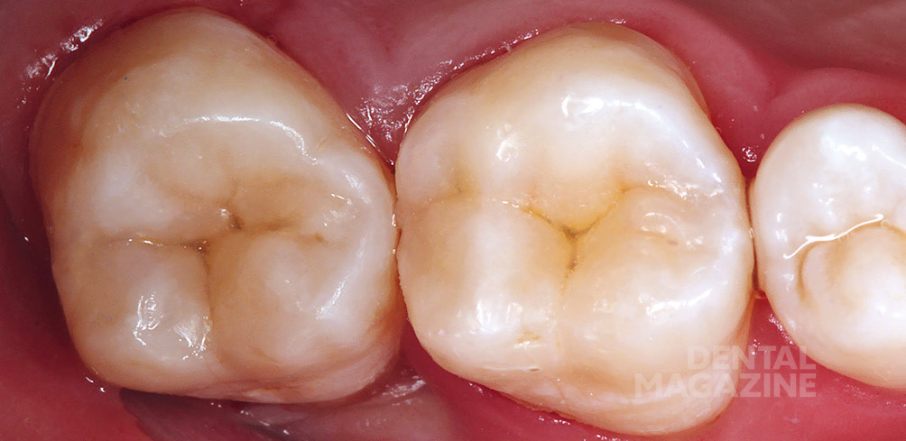 Реставрация жевательного зуба 
