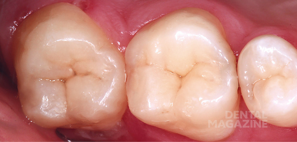 Восстановление жевательного зуба