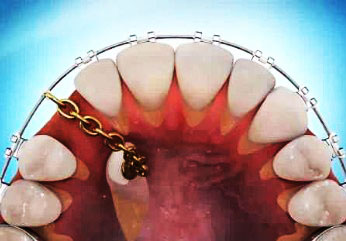 Диагностика причин ретенции отдельных зубов