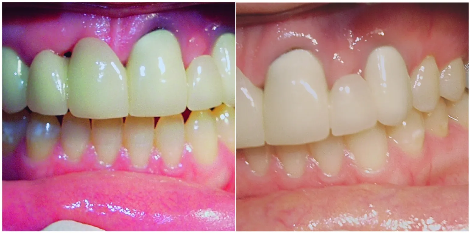 Loss of bone and gingiva, dark triangle