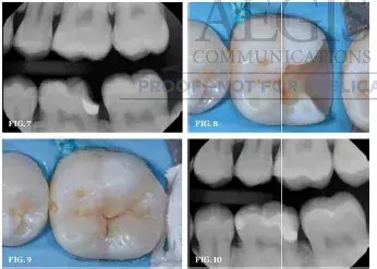 Biomimetic concept in tooth restoration