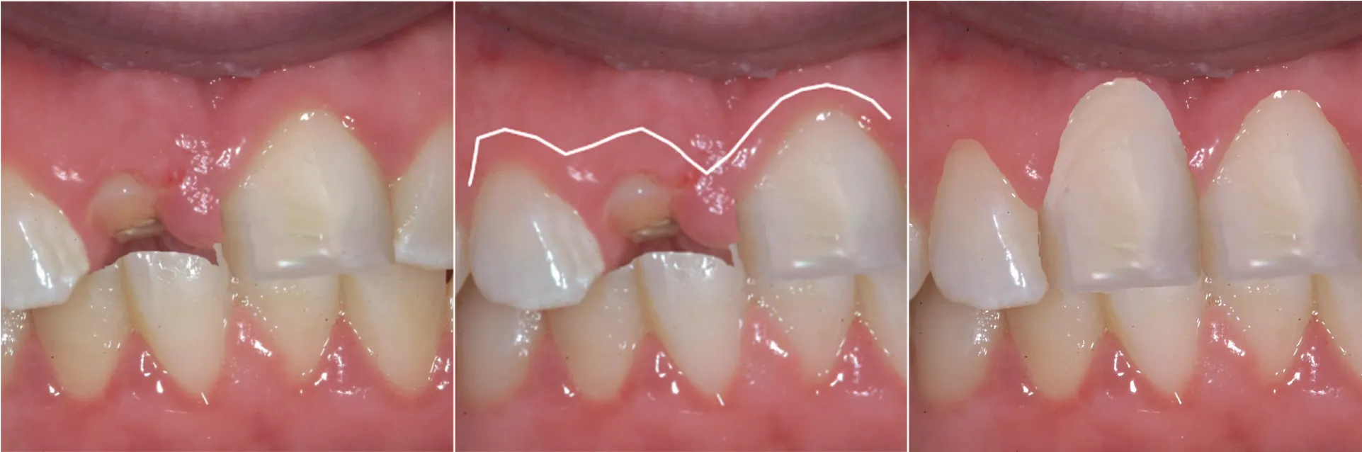 Surgical crown lengthening