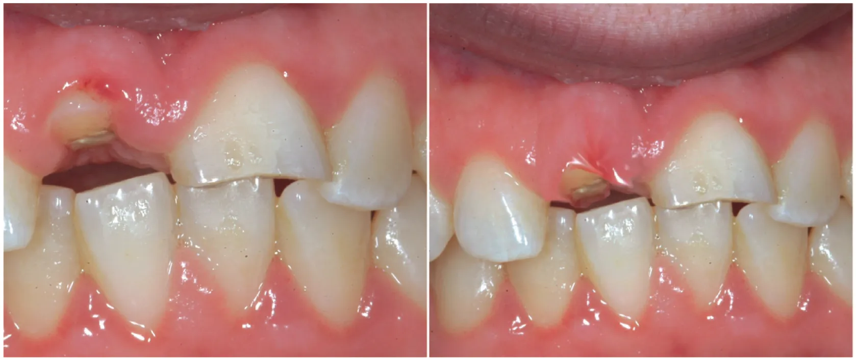 Crown lengthening