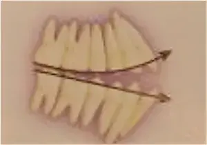 Divergent occlusal plane