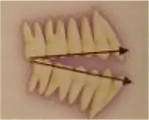 Divergent occlusal plane