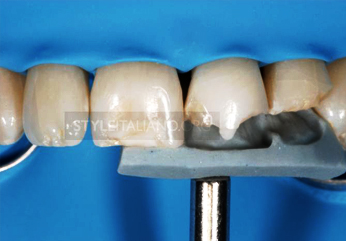 Постэндодонтическая Реставрация Фронтальных Зубов Клинический Случай Велосипедная Травма Результат Через 10 Лет