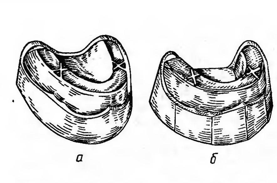 Определение центрального соотношения челюстей