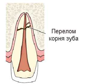 травма зубов