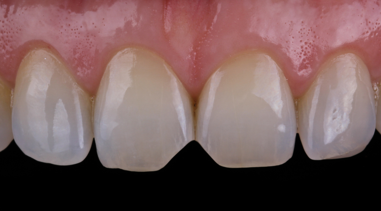 Рис. 2. Зубы имеют поверхность с минимальным микрорельефом.