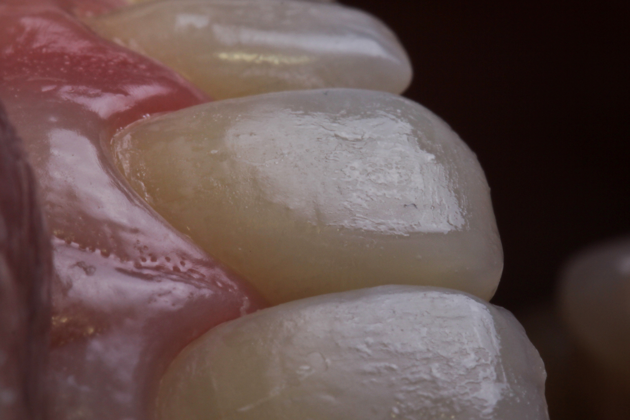Рис. 7. Вид зубов после завершения нанесения и адаптации слоев композита. 