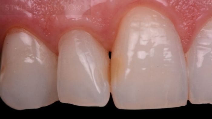 восстановление контактного пункта зубов
