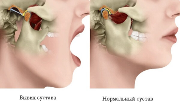Переломы нижней челюсти у детей