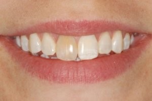 Chronic Pulpitis