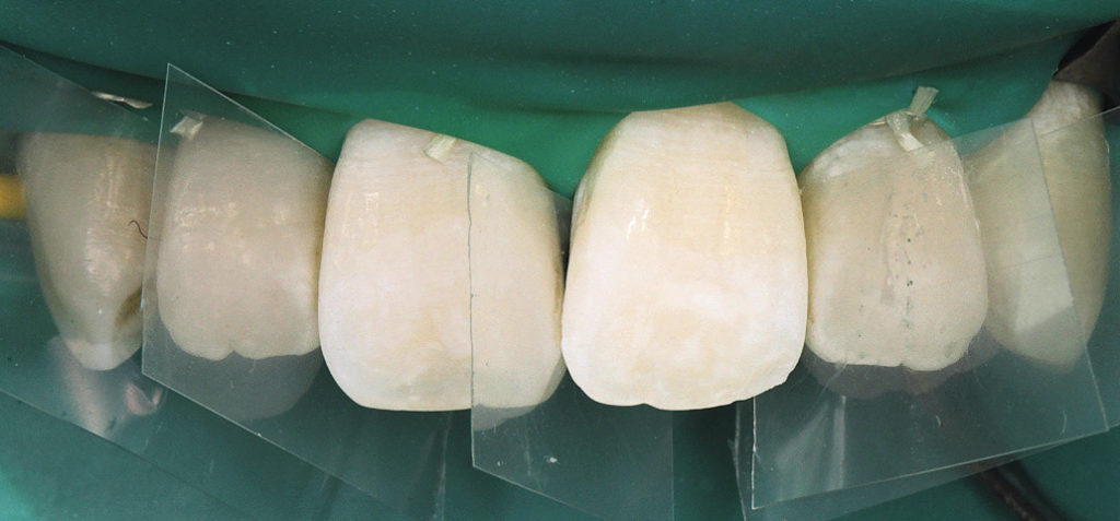 Рис. 7. Вид зубов после пескоструйной обработки и протравки. Зубы отделены друг от друга лавсановыми матрицами, чтобы не допустить попадания адгезива на контактный пункт.
