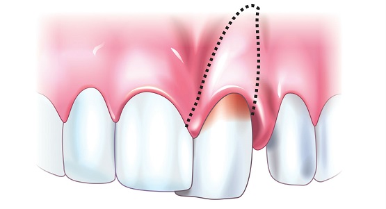 Травма Зубов-Диагностика и Лечение