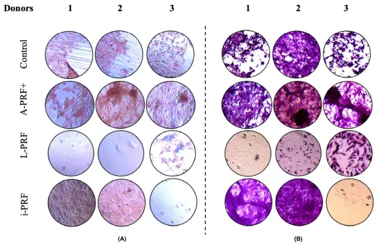 An in vitro study into three different PRF preparations for osteogenesis potential