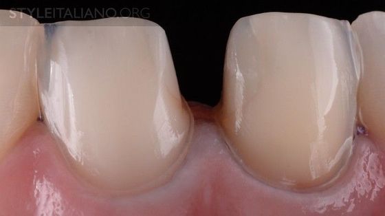 Поддесневое Препарирование Зуба — Пошаговый Протокол
