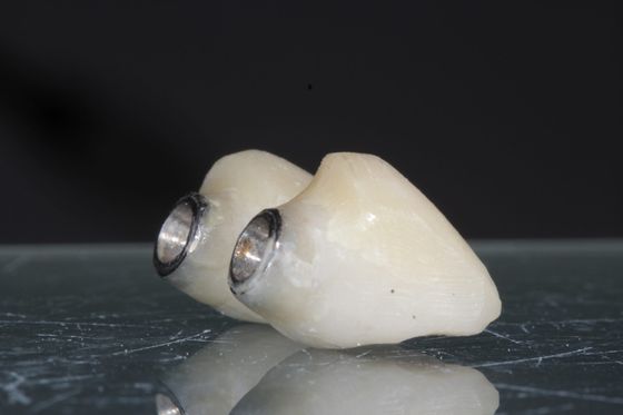 Ортодонтическое Вытяжение Зубов Как Подготовка К Имплантации
