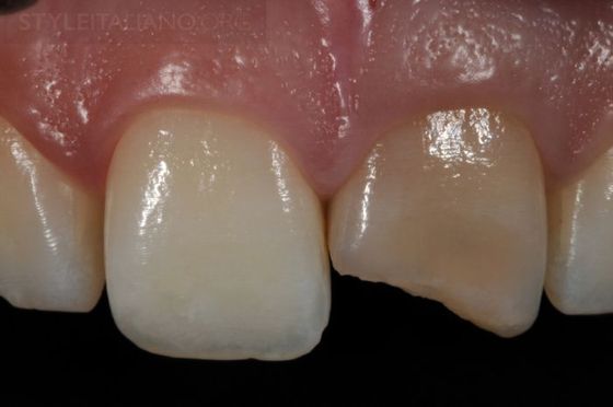 Восстановление потемневших фронтальных зубов