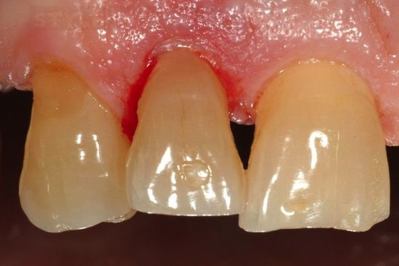 Лечение Перелома Коронки Зуба