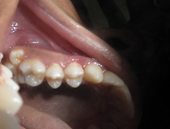 Сверхкомплектные зубы на верхней челюсти с обеих сторон