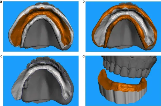 Interarch space assessment in edentulous patients rehabilitated with complete removable dentures using open-access software
