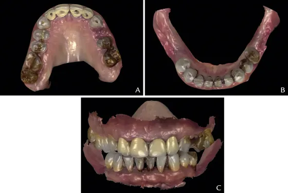 Fabrication of a facially generated tooth reduction guide for minimally invasive preparations: A dental technique