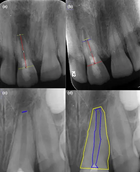 The effect of platelet-rich plasma as a scaffold in regeneration/revitalization endodontics of immature permanent teeth assessed using 2-dimensional radiographs and cone beam computed tomography: a randomized controlled trial 