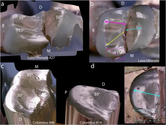 Fractography of Clinical Failures of Indirect Resin Composite Endocrown and Overlay Restorations