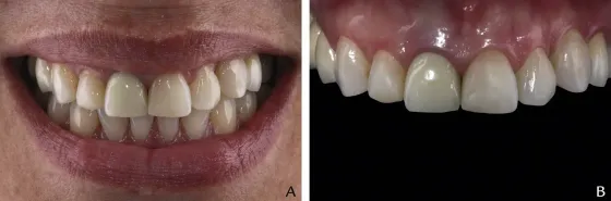 Color Change, Tooth Sensitivity, Aesthetic Self-Perceptions and Quality of Life after At-Home Dental Bleaching