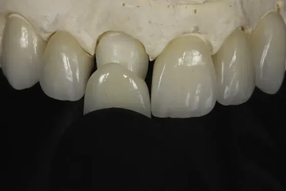 Adhesion and Optics: The Challenges of Esthetic Oral Rehabilitation on Varied Substrates - Reflections Based on a Clinical Report