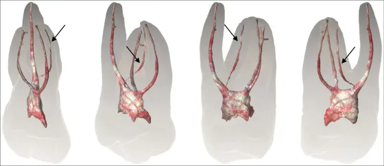 Identification and Characterization of a Previously Undiscovered Anatomical Structure in Maxillary Second Molars: The Palato-Mesiobuccal Canal