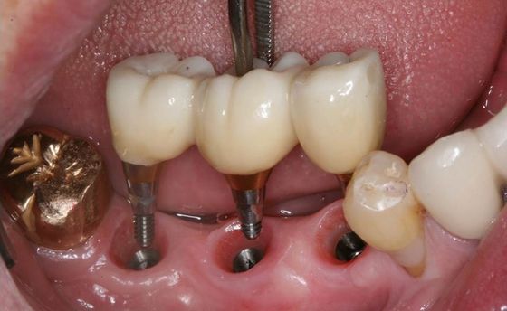 Implant placement with IS-III active fixtures in the posterior mandible