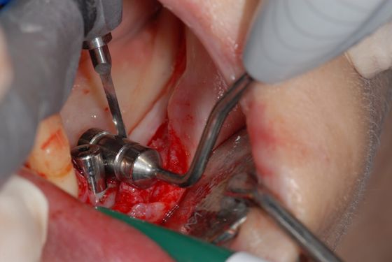 Идеальное расстояние между зубом и имплантатом