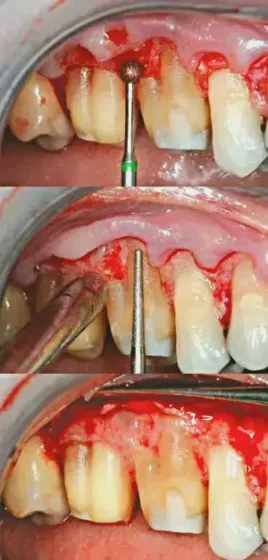 The Use of PerioDerm™ for Root Coverage and Correction of Insufficiently Attached Gingiva