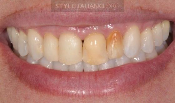 Потемнение Зубов: Отбеливание И Реставрация Чрезвычайно Темных Зубов