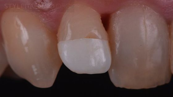 Дегидратированный фрагмент зуба