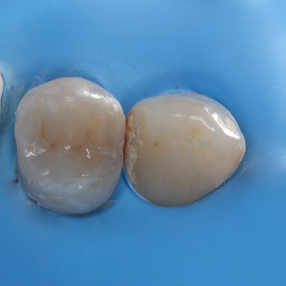 Decision making for direct posterior restorations