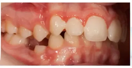 Papel del Odontólogo en pacientes con dificultades de aprendizaje. Revisión y puesta al día