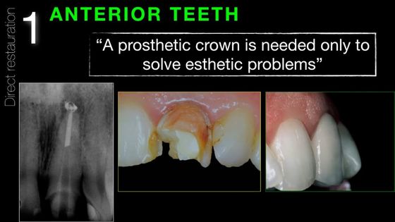 Post Endodontic Restoration: from root canal preparation to occlusal check. Overview by Giovanni Cavalli