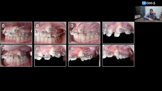 TADs y alineadores. Tratamiento precoz. Ortodoncia digital. Asimetria facial. Reseña del curso