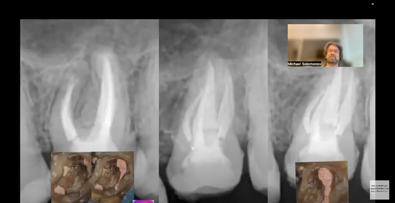 5 root canals endodontic retreatment