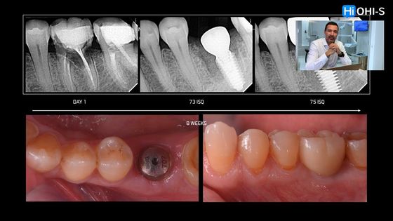 Immediate implant placement. Everything you need to know. Overview by Nicolas Aronna Mallia