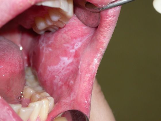 Лейкоплакия полости рта. Симптомы и лечение