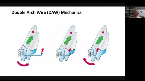 🙌 The video explains how the double wire arc method works
