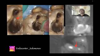Клинический случай по эндодонтическому перелечиванию с редкой анатомией корневых каналов