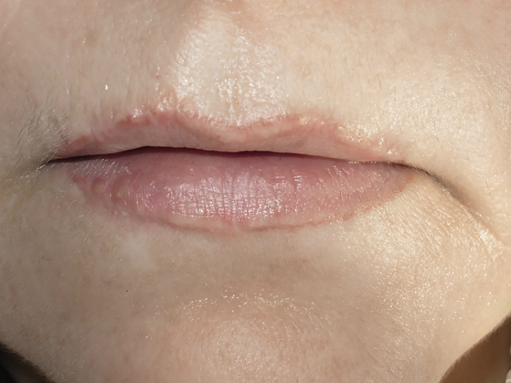 осложнения косметологии губ