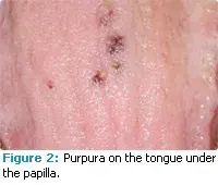 Purpura on the tongue