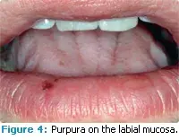 Treating Patients with Immune Thrombocytopenic Purpura