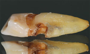 циркулярный кариес корня зуба